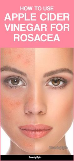 ACV aids in eliminating toxins and is a natural disinfectant which helps in reducing bacteria and yeasts on the skin, and thus forms a useful treatment for rosacea. Red Face Remedies, Redness On Face, Face Remedies, Natural Disinfectant, Natural Face Skin Care, Skin Natural Remedies, Red Face, Saggy Skin