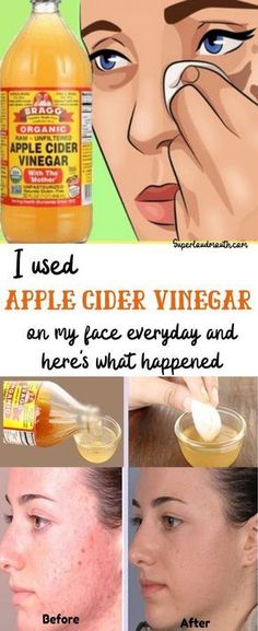 Apple Cider Vinegar For Acne, Acv Toner, Apple Cider Vinegar Toner, Cider Vinegar Benefits, Apple Cider Vinegar For Skin, Apple Cider Vinegar Benefits, Vinegar Uses, Apple Cider Benefits, Organic Apple Cider