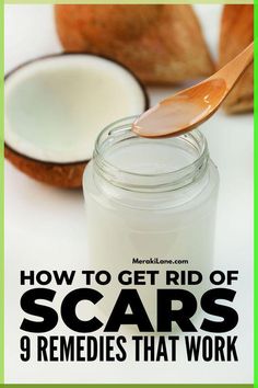 9 Natural Remedies for Scars that Actually Work! | If you want to know how to get rid of scars, this post is for you. Whether you have keloid, hypertrophic, atrophic, burn, or acne scars on your face, arms, legs, or anywhere for that matter, there are lots of home remedies you can try using ingredients you probably already have in your pantry. Click for a list of the best products and tips to fade scars and (hopefully) get rid of them completely. Get Rid Of Scars, Acne Scar Remedies, Getting Rid Of Scars, Scar Remedies, How To Fade, Lighten Scars, Natural Acne Remedies, Skin Natural Remedies, Home Remedies For Acne