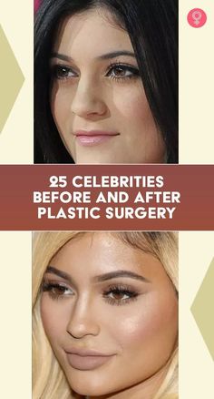 Celebrity Plastic Surgery Before After, Meghan Markle Nose Job, Nose Job Before And After, Bad Nose Jobs, Celebrity Nose Jobs, The Perfect Nose, Bad Celebrity Plastic Surgery, Extreme Plastic Surgery, Celebrity Surgery