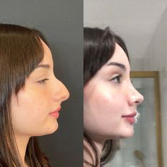 Before And After Contouring, Revision Rhinoplasty, Nose Profile, Plastic Surgery Photos