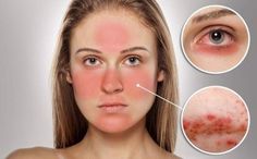 Die richtige Ernährung bei Rosacea kann das Hautbild deutlich verbessern und die Symptome der entzündlichen Hauterkrankung mildern. Neck Acne, Cystic Pimple, Pimples Under The Skin, Under The Skin, Lifestyle Motivation, How To Treat Acne, Aesthetic Ideas, Natural Treatments, Aging Skin