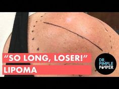 Click here to subscribe to Dr. Pimple Popper: https://www.youtube.com/@DrPimplePopper/Join All Access Memberships here:https://www.youtube.com/channel/UCgrsF... Head Pimples, Huge Pimple, Ear Pimple, Lipoma Removal, Pimple Popper Videos Black Heads, Pimple Popper Tool, Sandra Lee, Hygiene Routine, Kosher Recipes