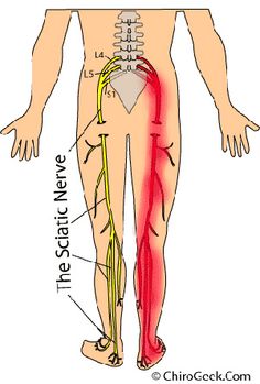 What's the Deal With Sciatica? A lot! The Sciatic nerve connects to the tailbone area of the spine and flows down the leg your ankle. Spinal troubles, excessive sitting or congestion of the buttocks area can cause or increase the pain of the sciatic nerve (Sciatica). Laser spinal surgery is one of the ONLY options for pain free living. Contact Jessica@AktivateGroup.com for more information. Sciatic Nerve Pain Relief, Sciatica Exercises, Sciatica Relief, Sciatic Nerve Pain, Sciatica Pain, Sciatic Nerve, Carpal Tunnel