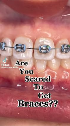 Tips For Braces, Braces Colours, Braces Food, Braces Ideas, Braces Pain, Cute Braces Colors, Pretty Teeth