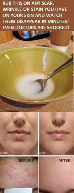 Skin Care Wrinkles, Beauty Remedies, Skin Remedies, Anti Aging Skin, Skin Products, Homemade Beauty Products, Anti Aging Skin Products, Health And Beauty Tips, Beauty Treatments