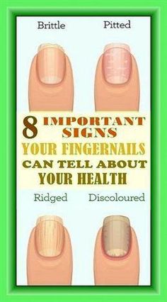 Nail Conditions, Striped Nails, Nail Fungus, Nail Health, Healthy Beauty, Yellow Nails, Unwanted Hair