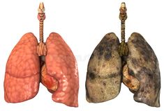 Lungs of a smoker. And healthy lung on white royalty free illustration Human Body Science Projects, Lung Anatomy, Human Body Science, How To Help Nausea, Constant Headaches, Uses For Vicks