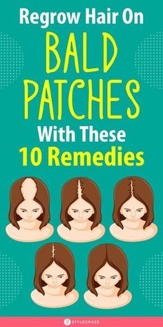 Hair Care Remedies, Bald Patches, Hair Growing Tips, Hair Remedies For Growth, Regrow Hair, Hair Remedies