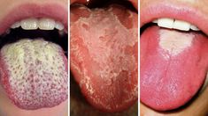 This is What Your Tongue Has to Say About Your Health!. A large portion of us don't generally consider our tongues every day. They're one of those body parts... Tongue Infection, High Protein Meal Plan, Protein Meal Plan, High Protein Meal, Underarm Odor, Lose Thigh Fat, Protein Meal, Hormone Health