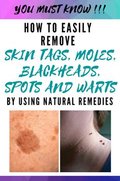 Parcels of individuals now and again have issues, for example, clogged pores, skin labels, moles, and skin inflammation.  #SkinTags #Moles #Blackheads #Spots And #Warts Avacado Dinner, Tagine Recipes Chicken, Meatless Meals Easy, Fritatta Recipe, Instapot Recipes Chicken, Tofu Recipes Healthy, Chicken Thights Recipes, Remove Skin Tags, Shredded Chicken Recipes