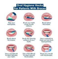 ORAL HYGIENE HACKS FOR PATIENTS WITH BRACES Hygiene Hacks, Mouth Hygiene, Essential Oils For Pregnancy, Natural Face Care, Brace Face, Orthodontics Braces, Lower Back Pain Exercises