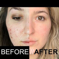 Girl With Acne, Expensive Products, Acne Tips, Fungal Acne, Forehead Acne, Bad Acne, Face Pores, Prevent Pimples, Natural Acne Remedies