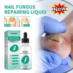 Kerassentials for Toenail-Fungus, Kerassentials-Toenail Fungus-Treatment O NICE Nail Conditions, Nail Problems, Foot Nail, Nail Infection, Fungal Nail, Nail Repair, Damaged Nails, Nail Care Routine, Nail Oil