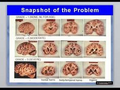 If you are reading this blog its likely that you have heard of homocysteine and know that is related to the methylation cycle.  And maybe you’ve even had your homocysteine levels tested recently.  But what you likely haven’t heard is what homocysteine actually DOES inside your body – and that is the focus of this … Adrenal Fatigue, Holistic Medicine, Biochemistry, How To Measure