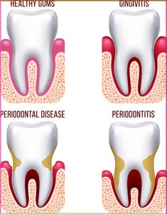 #DentalTip:  People do not realize they have gingivitis because it is not typically a painful condition. Know the symptoms of gingivitis and prevent Teeth Diseases, Tooth Infection, Remedies For Tooth Ache, Gum Recession, Loose Tooth, Receding Gums, Periodontal Disease, Disease Prevention, Prom Hairstyles