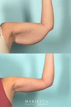 BeforeAfterBrachioplastyA Brachioplasty or arm lift is a procedure performed to remove excess skin and fat from the armsAn arm lift can help you obtain a more defined and toned appearance in the upper arm region. Before And After Arm Workout, Arms Before And After Toned, Before After Aesthetic, Arms Before And After, Skin Removal Surgery Before And After, Emsculpt Before And After