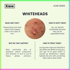 What is the cause of whiteheads? Whiteheads develop when dead skin cells, sebum (oil), and dirt clog your pores. Unlike blackheads, which can be pushed out, whiteheads are closed within the pore. This can make treatment a bit more challenging. Still, there's hope when it comes to getting rid of pesky whiteheads. Dermatology Notes, Whiteheads On Chin, White Head Removal, Skincare Notes, Esthetician Knowledge, Acne Quotes, Acne Awareness, Esthetician Skincare, Beauty Skin Quotes