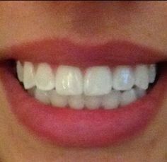 Good Teeth Smile, White Smile Aesthetic, Perfect Straight Teeth, Straight Teeth Smile, Straight Teeth Aesthetic, Teeth Claim, White Straight Teeth, Big Teeth Smile, White Teeth Aesthetic