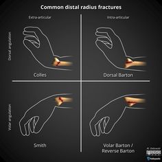 four different stages of an arm and hand with the words common distatalidus fractured