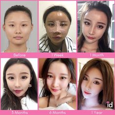 South Korean Plastic Surgery, Kpop Plastic Surgery, Jaw Reduction Surgery, Forehead Reduction, Face Plastic Surgery, Change Appearance, Nose Fillers