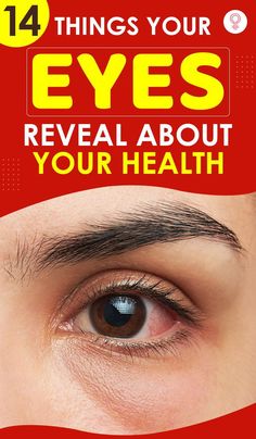 14 Things Your Eyes Reveal About Your Health: Most people suffer from one or the other disease without even realizing it since there are no ‘obvious’ symptoms. If you think you’re one of those (and even if you do not), check your eyes. They can reveal symptoms of conditions you may be suffering from. #health #wellness #healthcare #eyes Blood Vessel In Eye, Eye Medicine, Bloodshot Eyes, Eye Twitching, Eye Meaning, Lose Arm Fat, Eye Infections, Health Guru