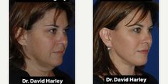 before and after photos of a woman's nose surgery