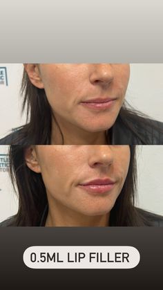 Natural Looking Lip Fillers Before And After, Small Lip Fillers Before And After, Lip Flip Vs Filler, Natural Lip Fillers Before And After, Upper Lip Filler, .5 Lip Filler