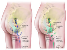 Pinched Nerve In Buttocks, Femoral Nerve Pain Relief, Pelvic Floor Dysfunction Exercises, Pelvic Congestion Syndrome, Femoral Nerve, Nurse Skills, Muscle System