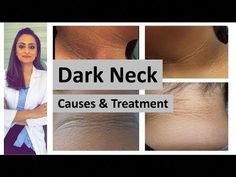 #darkneck #AcanthosisNigricans #DarkNeckTreatmentCauses of darkening in neck areaThis is a common complaint in our population. Causes:Acanthosis nigricans: d... Clean Neck Skin, Acanthosis Nigricans, Baking Soda Cleaning, Beauty Tips For Face