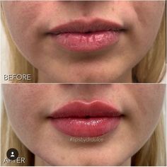 Lip Injections Juvederm, Dermal Fillers Lips, Lips Fillers, Lips Shape, Botox Lips, Facial Fillers, Kiss Lips