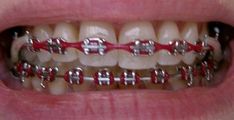 Red Power Chain Braces, Red Braces Teeth, Red Braces Aesthetic, Red Braces Color, Dark Red Braces, Maroon Braces, Chain Braces, Burgundy Braces, Power Chains