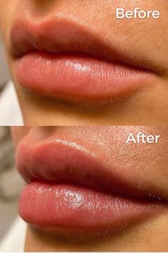 Lip Plastic Surgery, Dermal Fillers Lips, Cosmetic Fillers, Lip Care Tips, Face Fillers, Upper Lip Hair, Beauty Procedures