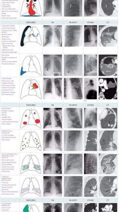 an image of different types of lunges and their locations in the chest, including lungs