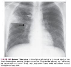 an x - ray shows the chest with a small arrow pointing to it