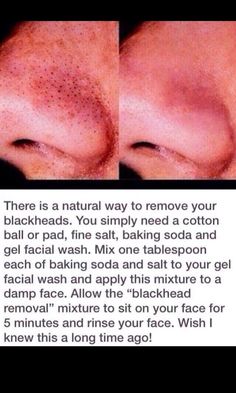 Getting Rid Of Stubborn Black Heads Blackhead Remedies, Black Heads, Blackhead Removal, Beauty Remedies, Homemade Beauty Products, Facial Wash, Blackhead Remover, Health And Beauty Tips, Skin Tips