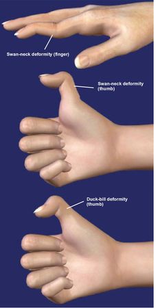 Swan Neck Deformity, Medical Horror, Musculoskeletal Pain, Duck Bill, Muscle Imbalance, Musculoskeletal System, Swan Neck, Chronic Illness, Physical Therapy