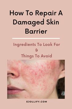 Skin Repair Remedies, How To Know If Your Skin Barrier Is Damaged, How To Fix Damaged Skin Barrier, Compromised Skin Barrier, Heal Skin After Picking, How To Heal Skin Barrier, Moisture Barrier Skin Care, How To Restore Skin Barrier, Heal Skin Barrier