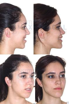 Corrective Jaw Surgery, Double Jaw Surgery, Teeth Aesthetic, Orthognathic Surgery, Plastic Surgery Fail, Face Fillers