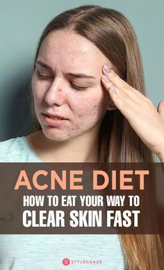 The foods you eat affect your skin directly. If you are unhappy with your skin, use this anti-acne diet to restore your skin Anti Acne Diet, Clear Skin Diet, Clear Skin Fast, Acne Diet, Forehead Acne, Motivasi Diet, Skin Diet, Bad Acne, Acne Free Skin