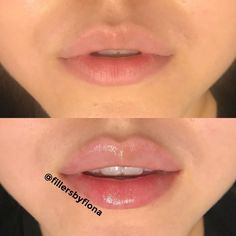 Natural Lip Fillers, Lip Background, Lips Quotes, Juvederm Lips, Lips Shape, Lips Sketch, Lips Painting