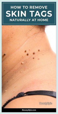 Amazing Advice-How To Get Rid Of  - Mole, Skin tags And Scars Naturally? by daor lemor | This newsletter was created with Smore, an online tool for creating beautiful newsletters for educators, nonprofits, businesses and more Remove Skin Tags, Home Remedy For Cough, Eye Exercises, Natural Sleep Remedies