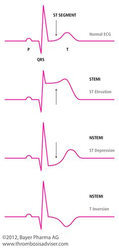 Stemi Ekg, Paramedic School, Nursing Information, Nursing School Essential, Nursing School Motivation, Nurse Study Notes, Nursing Mnemonics, Nursing Student Tips, Medical Student Study