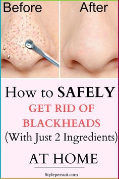 You can easily get rid of these blackheads by using natural or home remedies for blackhead treatment. Click to read How to get rid of blackheads diy| The best blackheads removal on nose| get rid of blackhads on face| get rid of blackheads on nose| how to get rid of blackheads naturally ... Blackheads On Face, How To Remove Blackheads, Remove Blackheads From Nose, Blackhead Remover Diy, Blackhead Extraction, Blackhead Remedies, To Remove Blackheads, Blackheads On Nose, Blackhead Mask