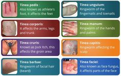 Tinea Pedis, Home Remedies For Allergies, Natural Remedies For Migraines, Dry Skin Remedies, Home Remedies For Hair, Fungal Infection, Homeopathy, Medicine