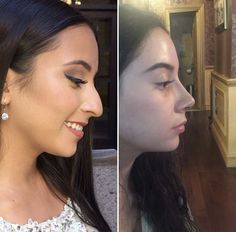 Rhinoplasty Before And After, Plastic Surgery Gone Wrong, Pretty Nose