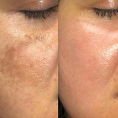 Derma Pen Treatment for Perfect Skin - Effects, Cost, Risks Hyperpigmentation Before And After, Derma Pen Before And After, Skin Pen Microneedling, Ipl Before And After, Dermapen Before And After, Micro Needling Before And After, Microneedling Before And After, Before After Skincare, Perfect Derma Peel