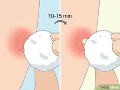 How to Instantly Get Rid of a Pimple (Cotton Ball Popping Method)
#skin care routine #skincare product #bubble skincare Ingrown Pimple, Cheek Pimples, Body Pimples, Deep Pimple, Lip Pimple, Zit Remedy, Painful Pimple, Dry Out Pimples, Cystic Pimple