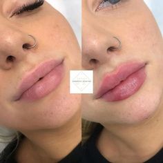 Jt Lips, Lips Injection, Lip Goals, Dermal Fillers Lips, Lip Permanent Makeup