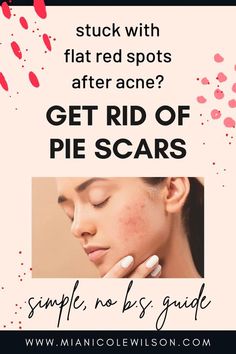 White Dots On Skin: Causes, Symptoms, Treatment And Prevention Red Acne Marks, Acne Scar Diy, Getting Rid Of Scars, Fade Acne Marks, How To Fade